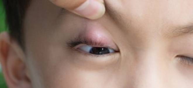 Можно ли ходить в садик с ячменем на глазу?