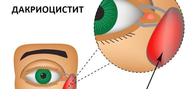 Можно ли гулять с ребенком если у него конъюнктивит?