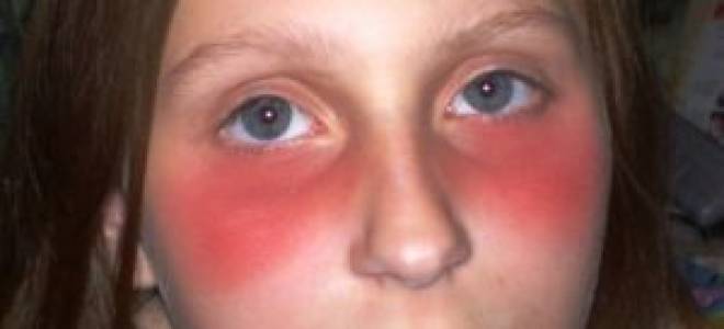 Конъюнктивит красные круги под глазами