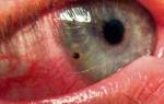 Болит глаз после удаления соринки из глаза