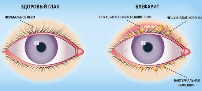 Болит веко под глазом что это может быть