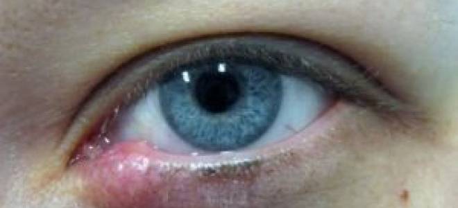 К какому врачу обращаться при ячмене на глазу у ребенка