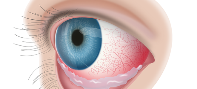 Могут ли болеть глаза при коньюктивите
