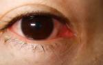 Что делать если глаза красные и слезятся и болят глаза?