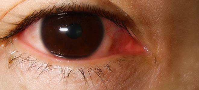 Что делать если глаз покраснел и слезится и болит?