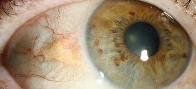 На глазу нарост и болит глаз