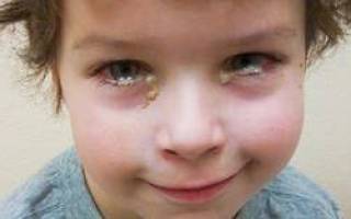 Глаз слезится и покраснел и болит у ребенка