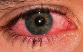 Можно ли заниматься спортом при вирусном конъюнктивите?