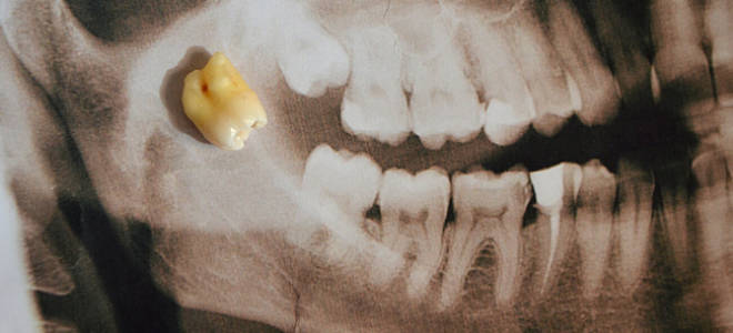Может ли болеть глаз при прорезывании зуба мудрости