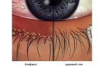Болезни глаз у человека список блефарит