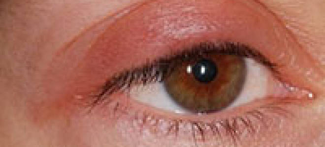 Опухло веко над глазом и болит что делать