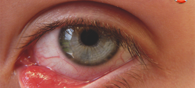 Как можно избавиться от ячменя на глазу в домашних условиях?