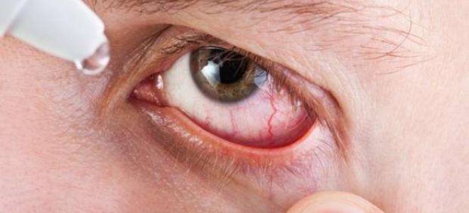 Как болят глаза при хламидиозе?
