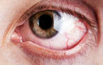 При сахарном диабете может ли глаза болеть