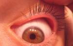 Болит глаз под верхним веком больно нажимать чем лечить дома