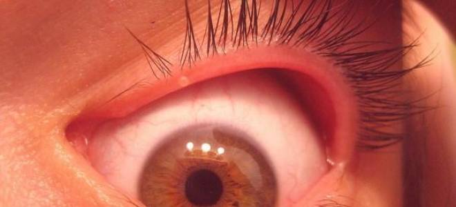 Воспалилось верхнее веко и болит глаз