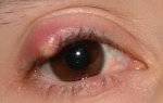 Ячмень и другие заболевания глаз