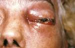 Грибковый конъюнктивит глаз лечение у взрослых