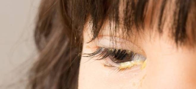 Глаза сильно слезятся и болят выделения липкие