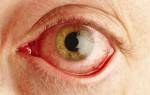 Как лечить аллергический конъюнктивит глаз у взрослых?
