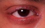 Аллергический блефарит симптомы и лечение