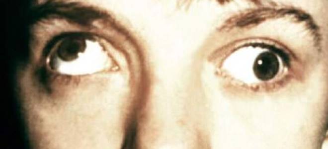 Глазодвигательные нервы и мышцы косоглазие