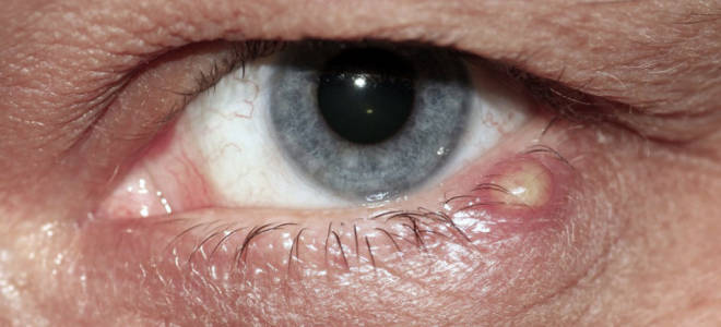 Как отличить ячмень на глазу от коньюктивита?