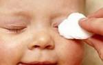 Психосоматика ячмень на глазу у ребенка