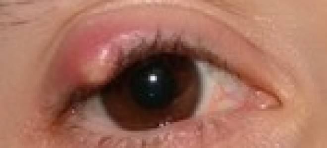 Ячмень на глазу с белой головкой