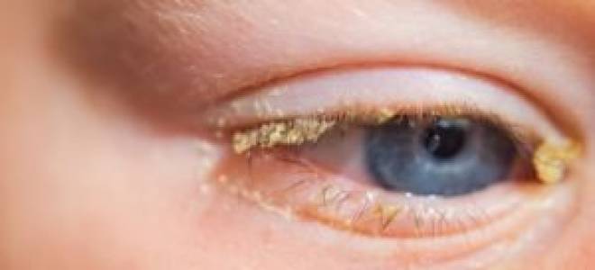 Болят глаза и закисают глаза