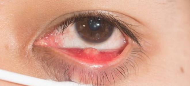 Как выдавить внутренний ячмень на глазу?