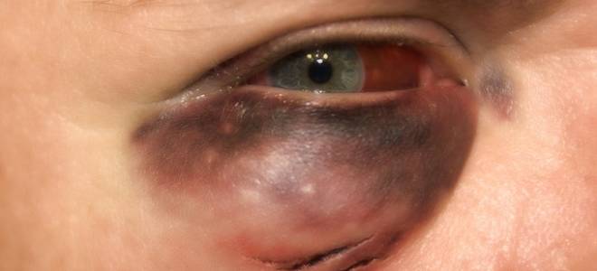Под глазом появилась припухлость красная и болит