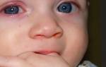 Сильный конъюнктивит у новорожденного не открывается глаз