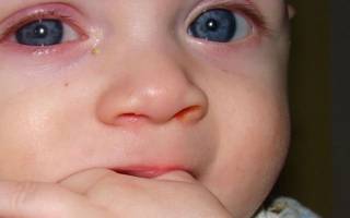 Сильный конъюнктивит у новорожденного не открывается глаз