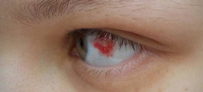 Если в глазу лопнул сосуд и глаз болит