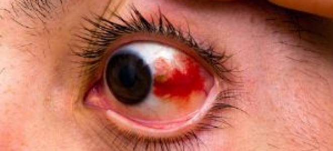 Ткнула веткой в глаз что делать покраснел и болит