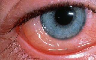 Восстановление зрения после аденовирусного конъюнктивита