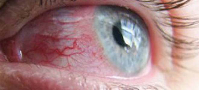 Воспалился глаз болит глазное яблоко