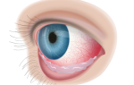 Конъюнктивит при глаукоме как лечить