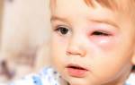 Ячмень на глазу как лечить у ребенка 3 года