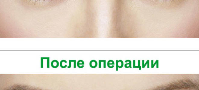 Можно ли исправить косоглазие после инсульта?