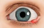 Что такое ячмень под глазом и как его лечить?