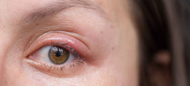 Можно ли красить глаза при блефарите?