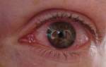 Аллергический конъюнктивит глаз лечение у взрослых народными средствами