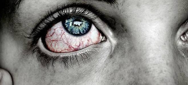 Что делать если покраснел глаз и болит и лезет гной?