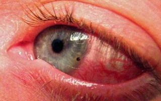 Как долго болят глаза после сварки?