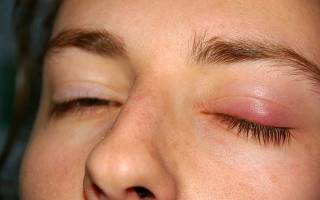 Болит глаз после удаления халязиона