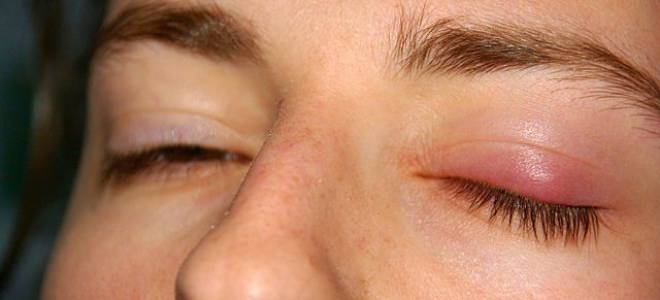 Болит глаз после удаления халязиона