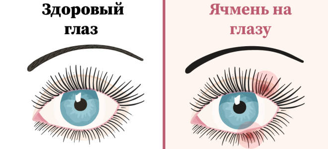Ячмень на глазу причины симптомы и лечение у мужчин