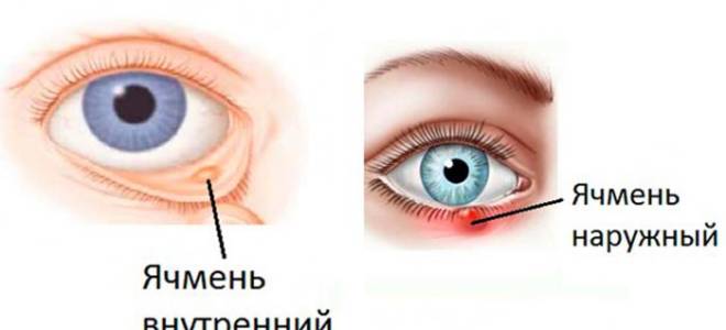 Писяк или ячмень на глазу